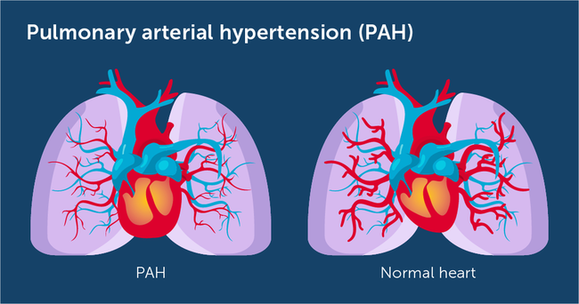 Pulmonary Arterial Hypertension