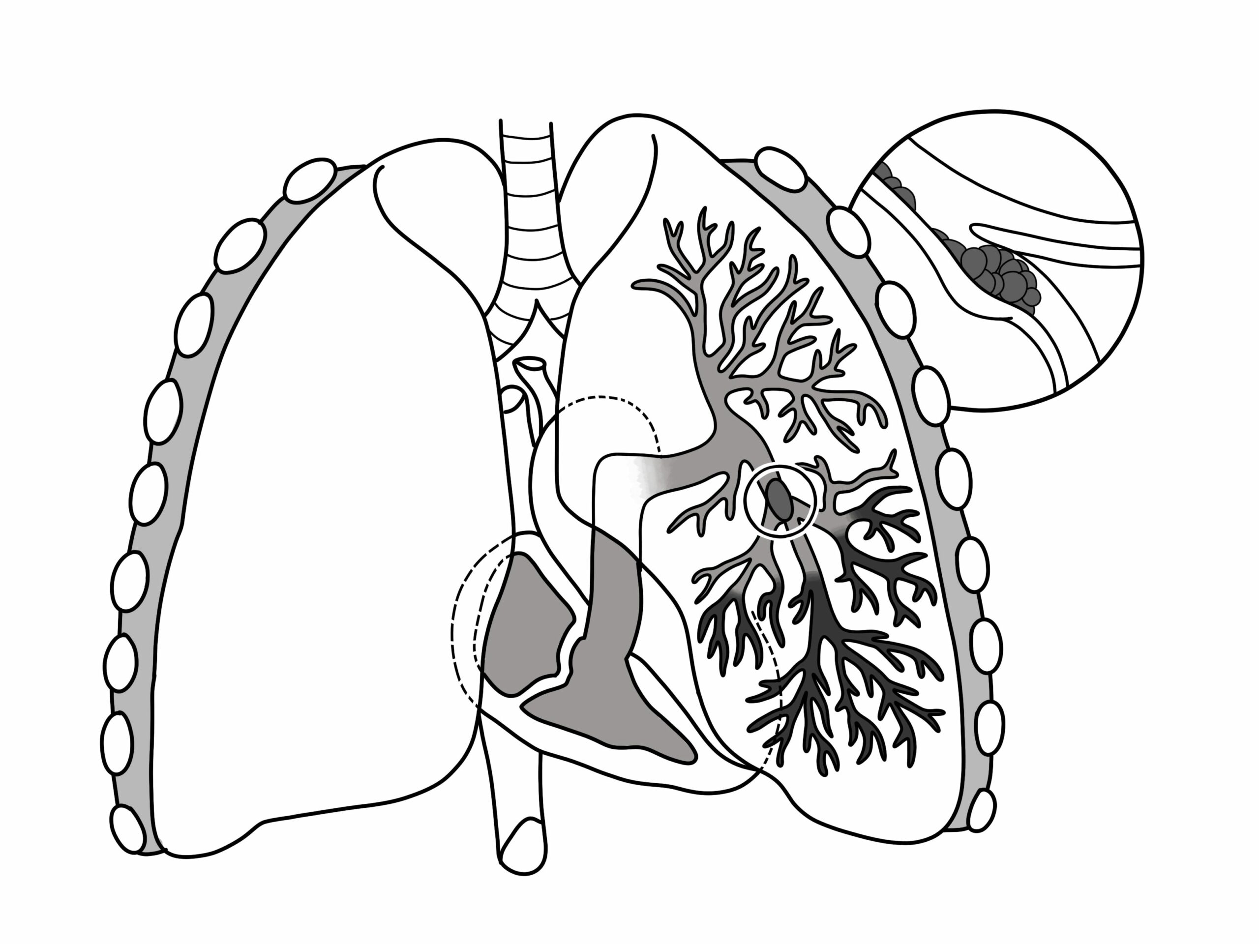 Pulmonary Embolism