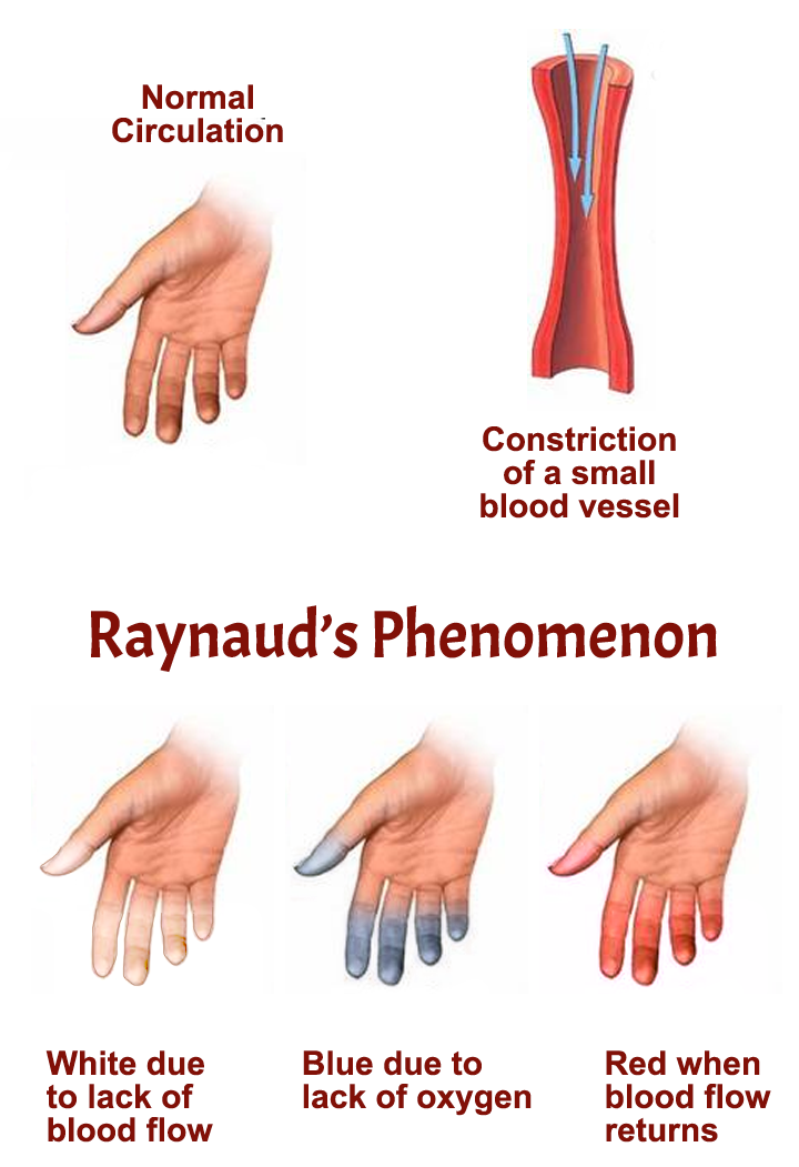 Raynaud’s disease