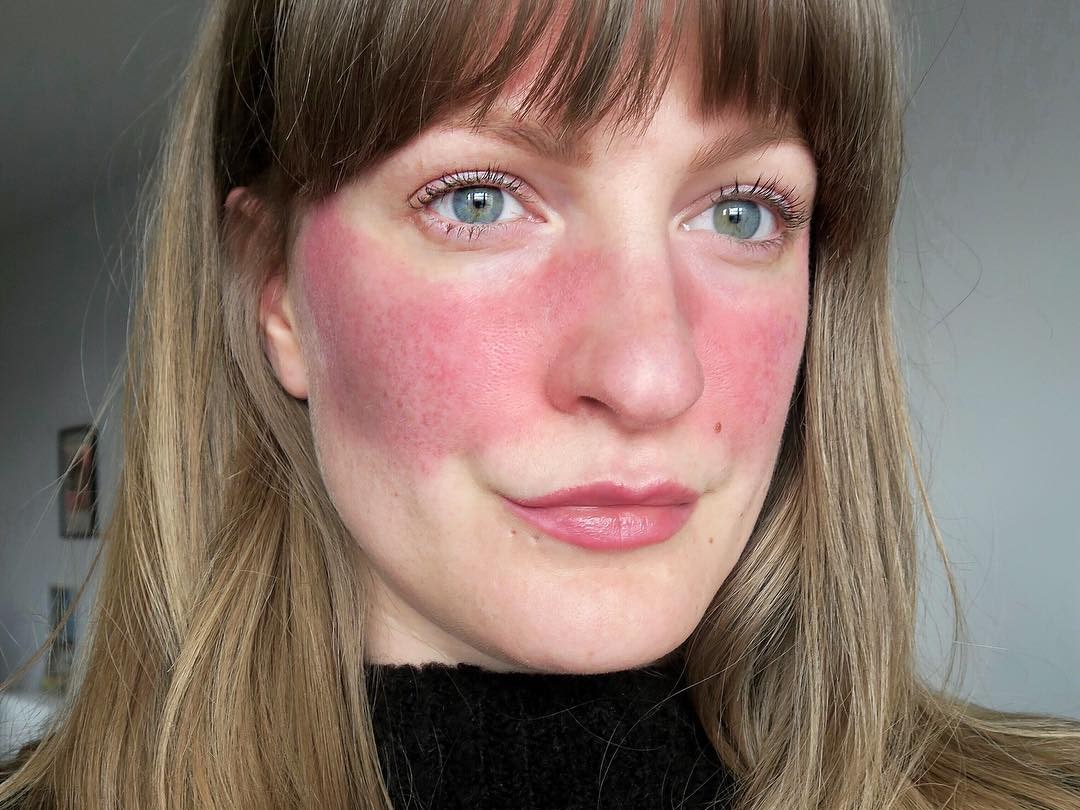 Rosacea