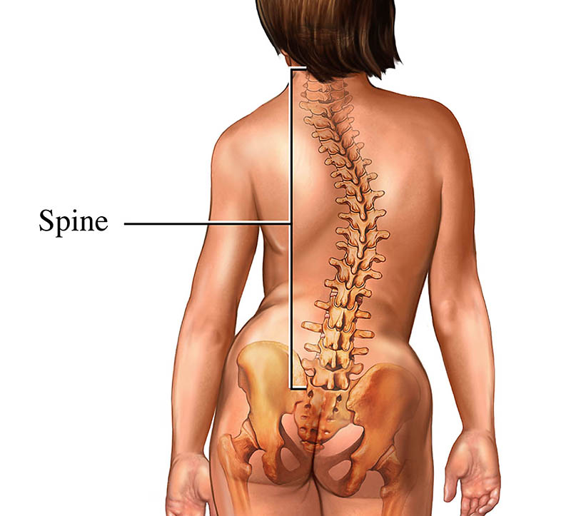 Scoliosis