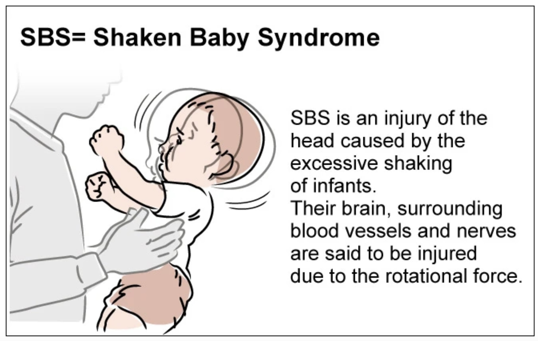 Shaken baby syndrome