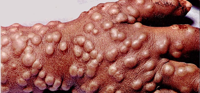 Smallpox