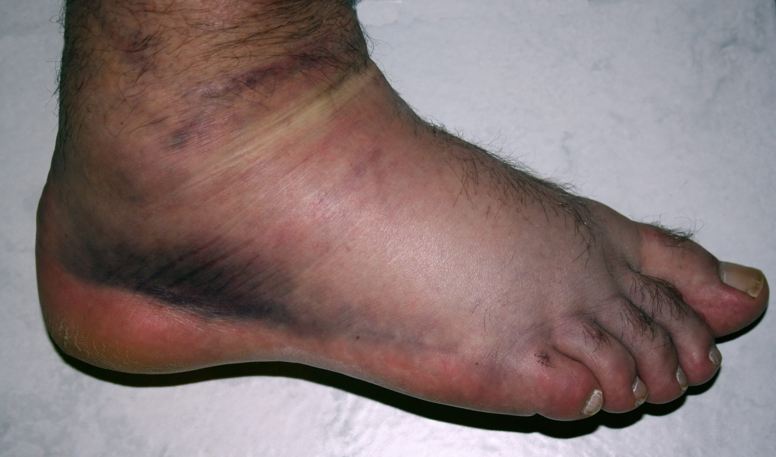 Sprained Ankle