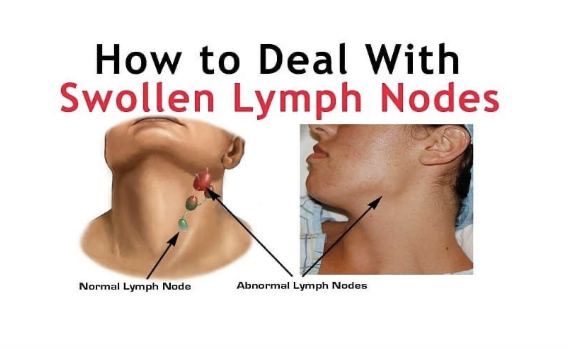 Swollen Lymph Nodes