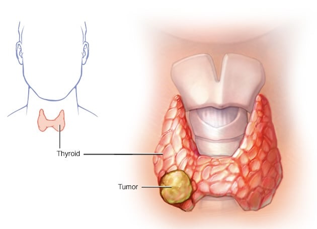 Thyroid Cancer