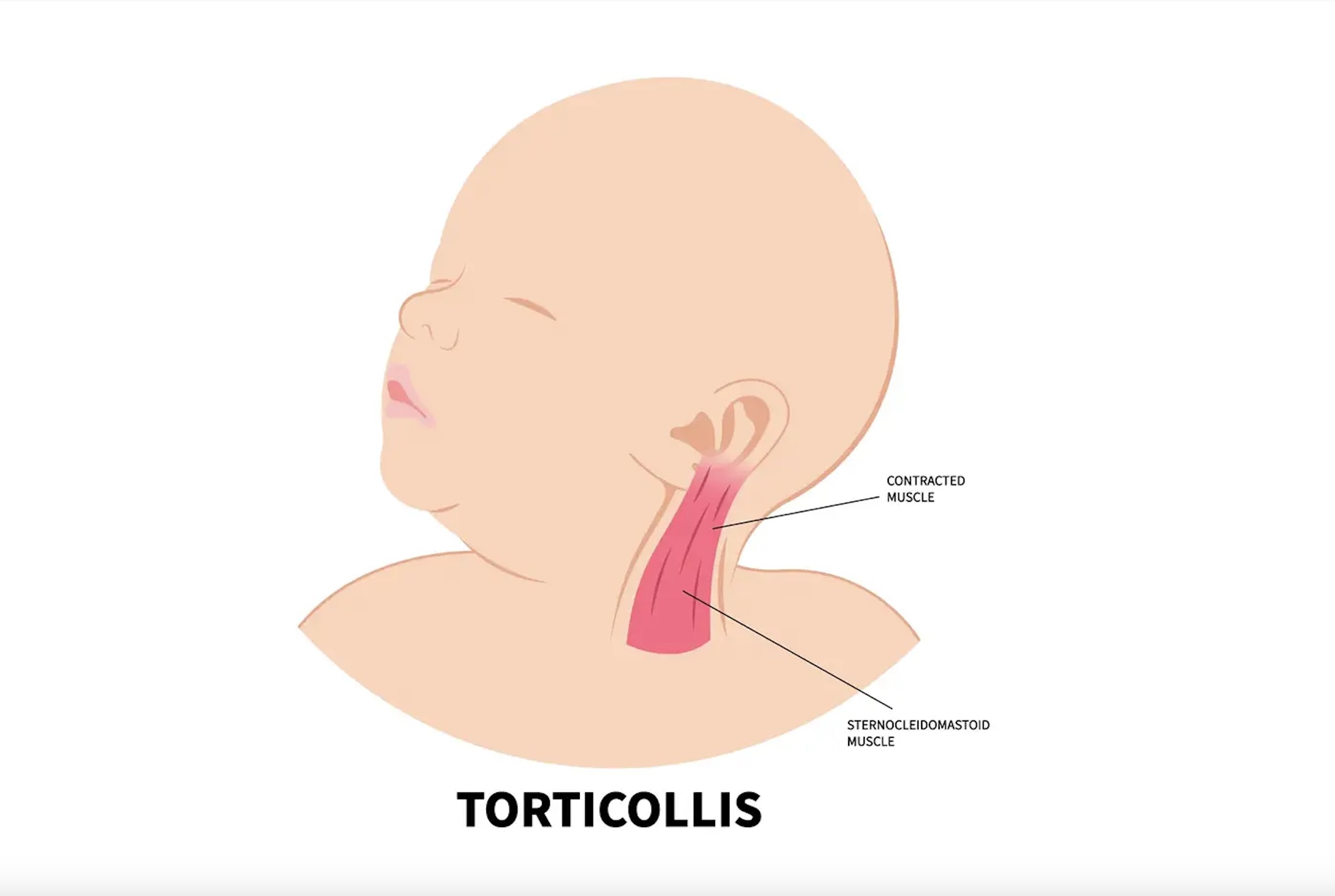 Torticollis