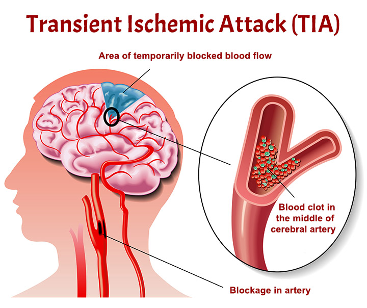 Transient Ischemic Attack (TIA)