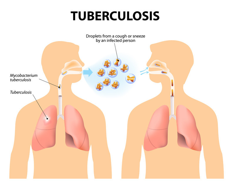 Tuberculosis