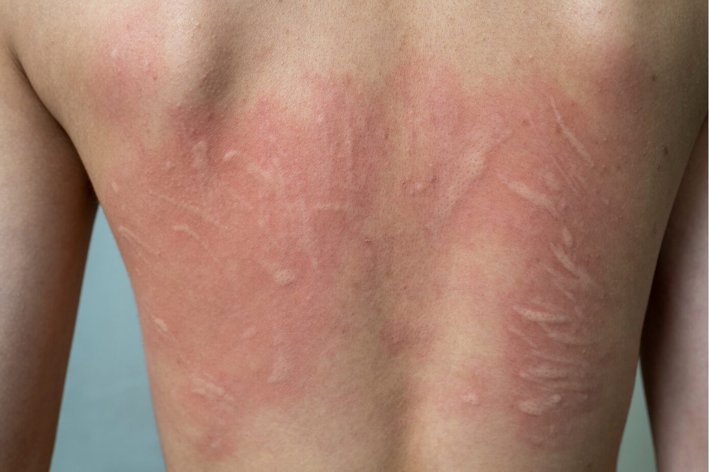 Urticaria