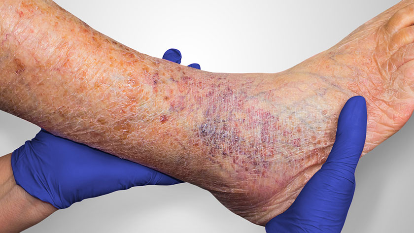 Venous Skin Ulcer