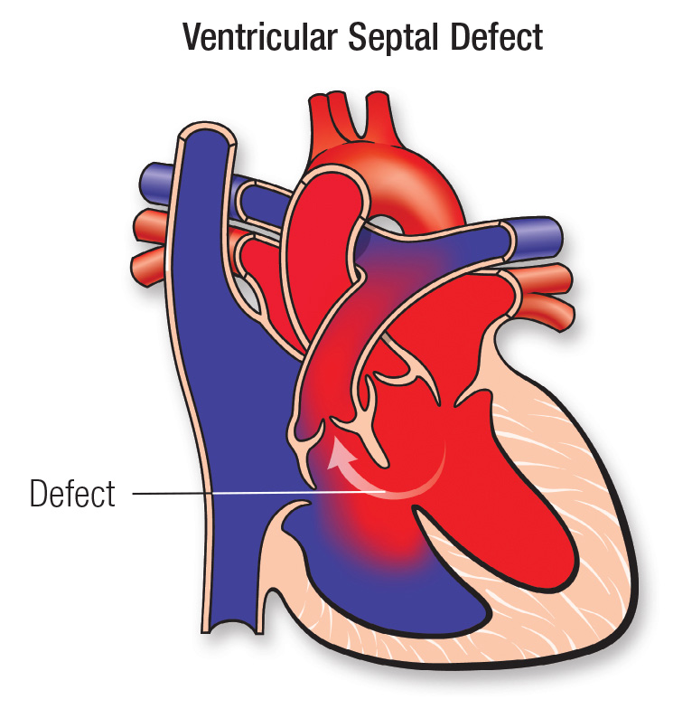 Ventricular Septal Defects