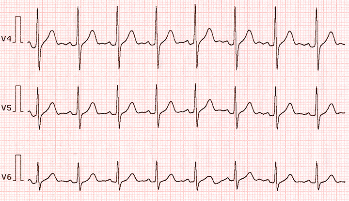 Ventricular Tachycardia