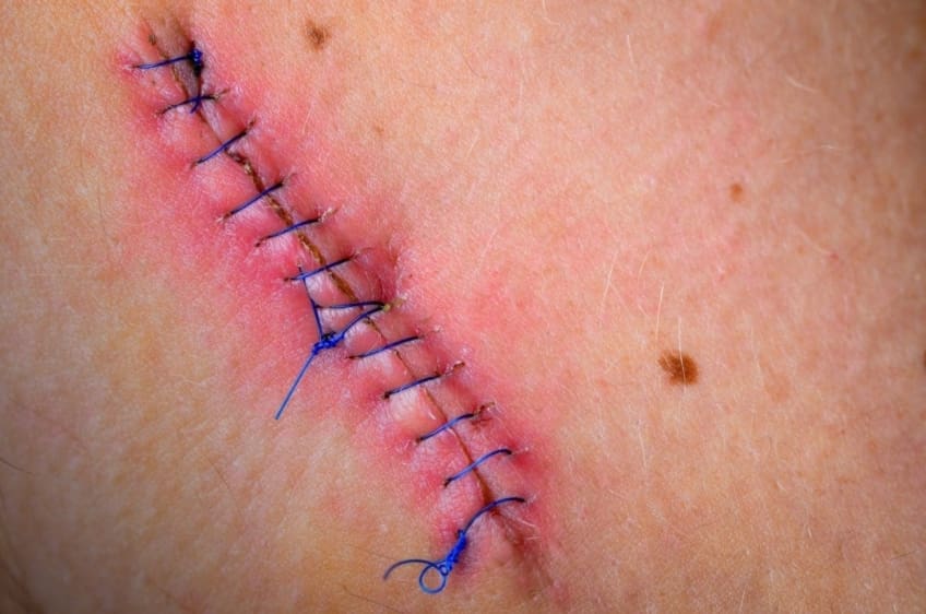 Wound After Surgery