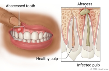 abscessed tooth