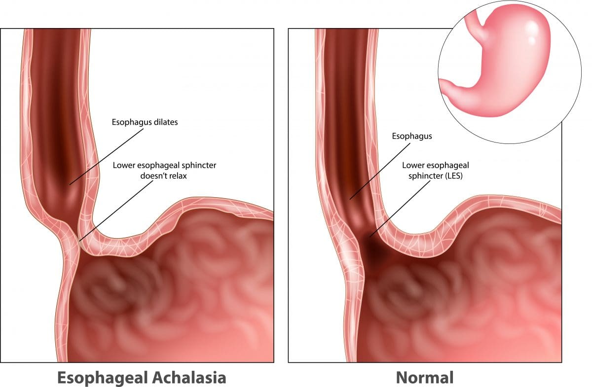 achalasia