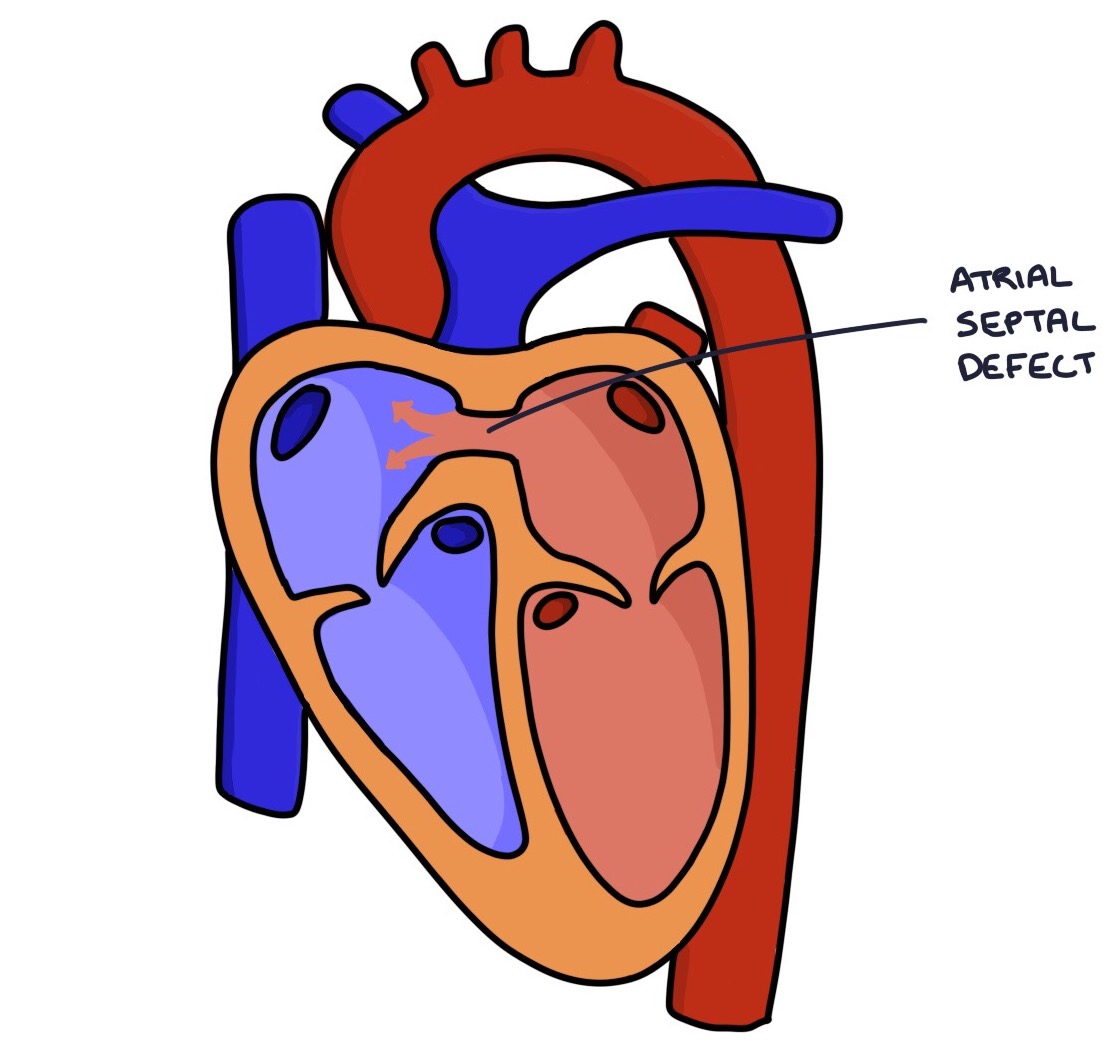 atrial septal defect