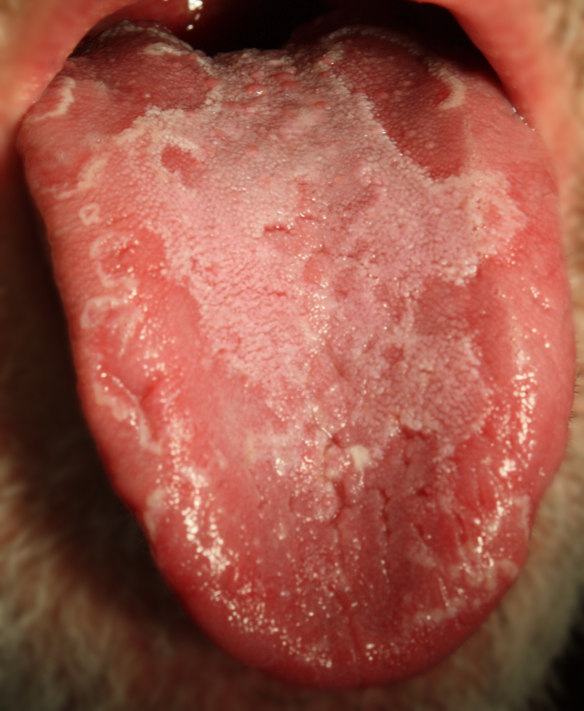 geographic tongue