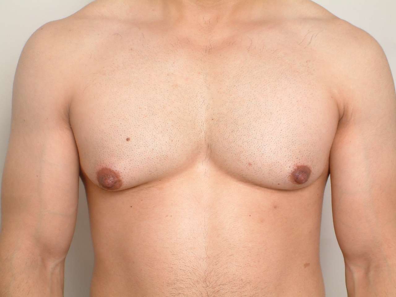 Gynecomastia