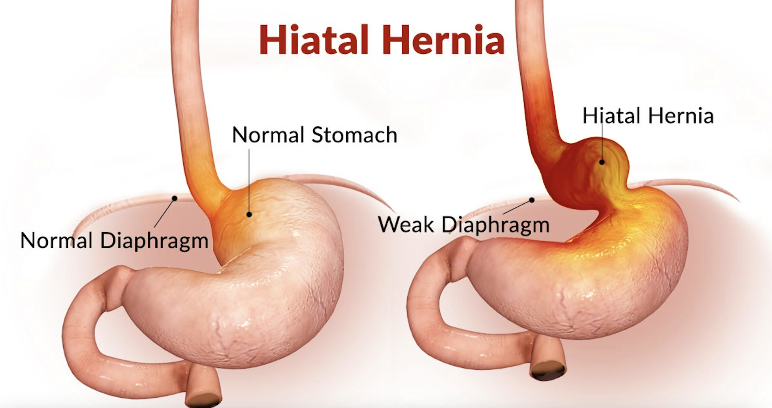 hiatal hernia