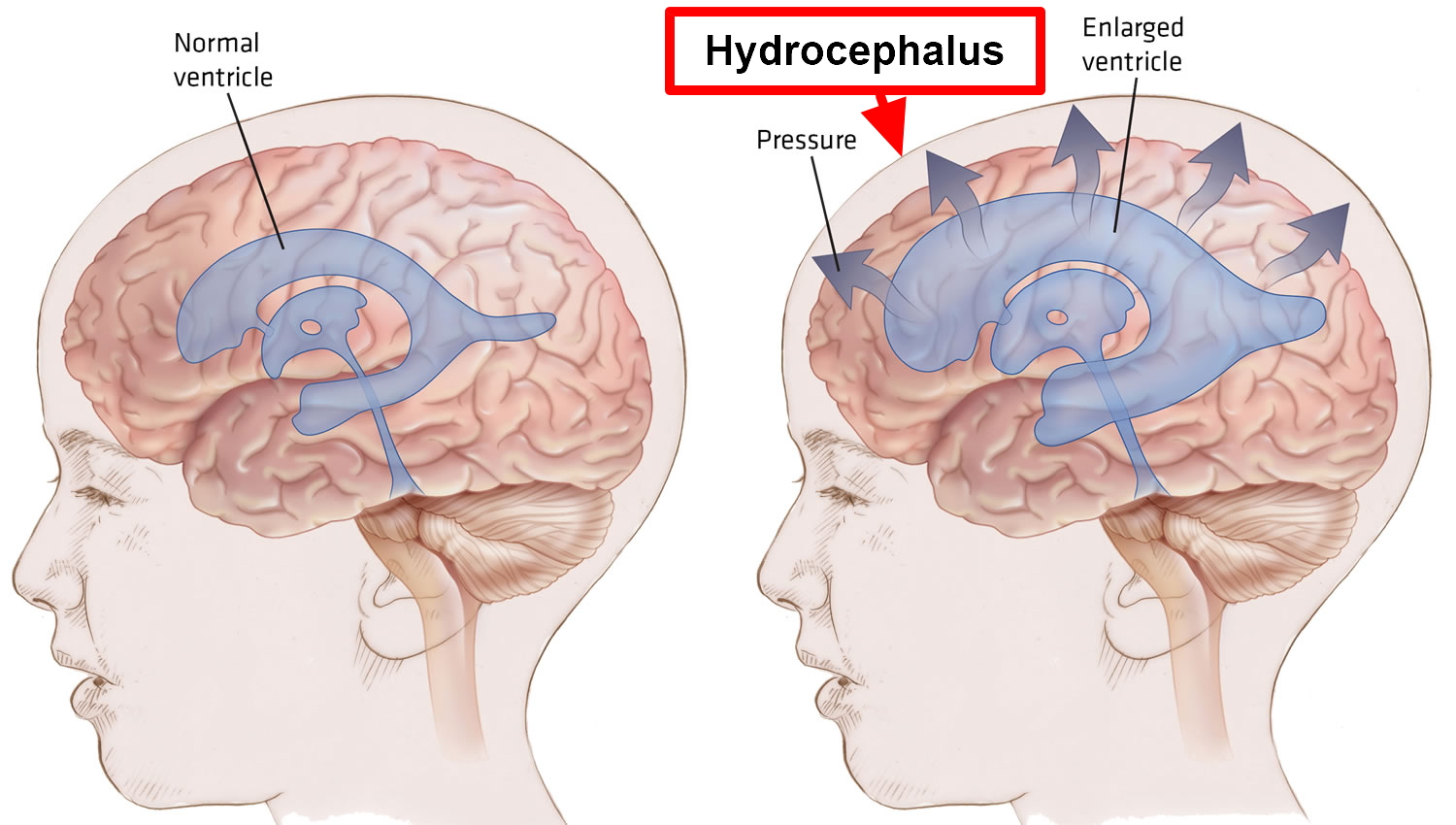 hydrocephalus