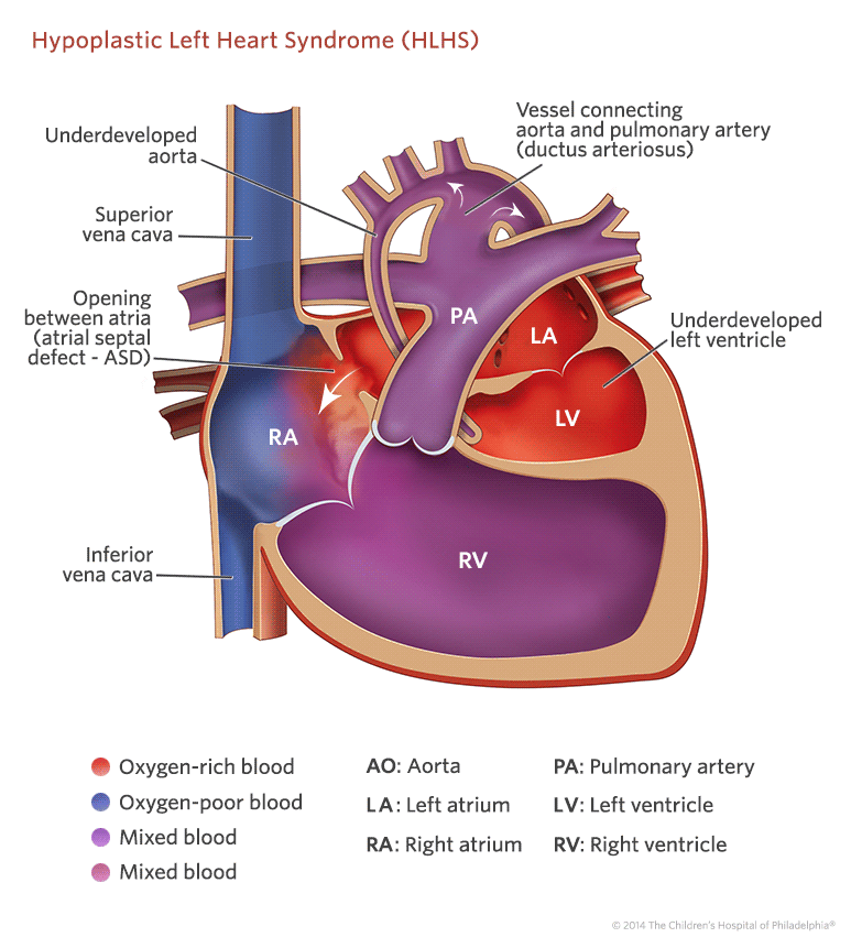 hypoplastic left heart syndrome