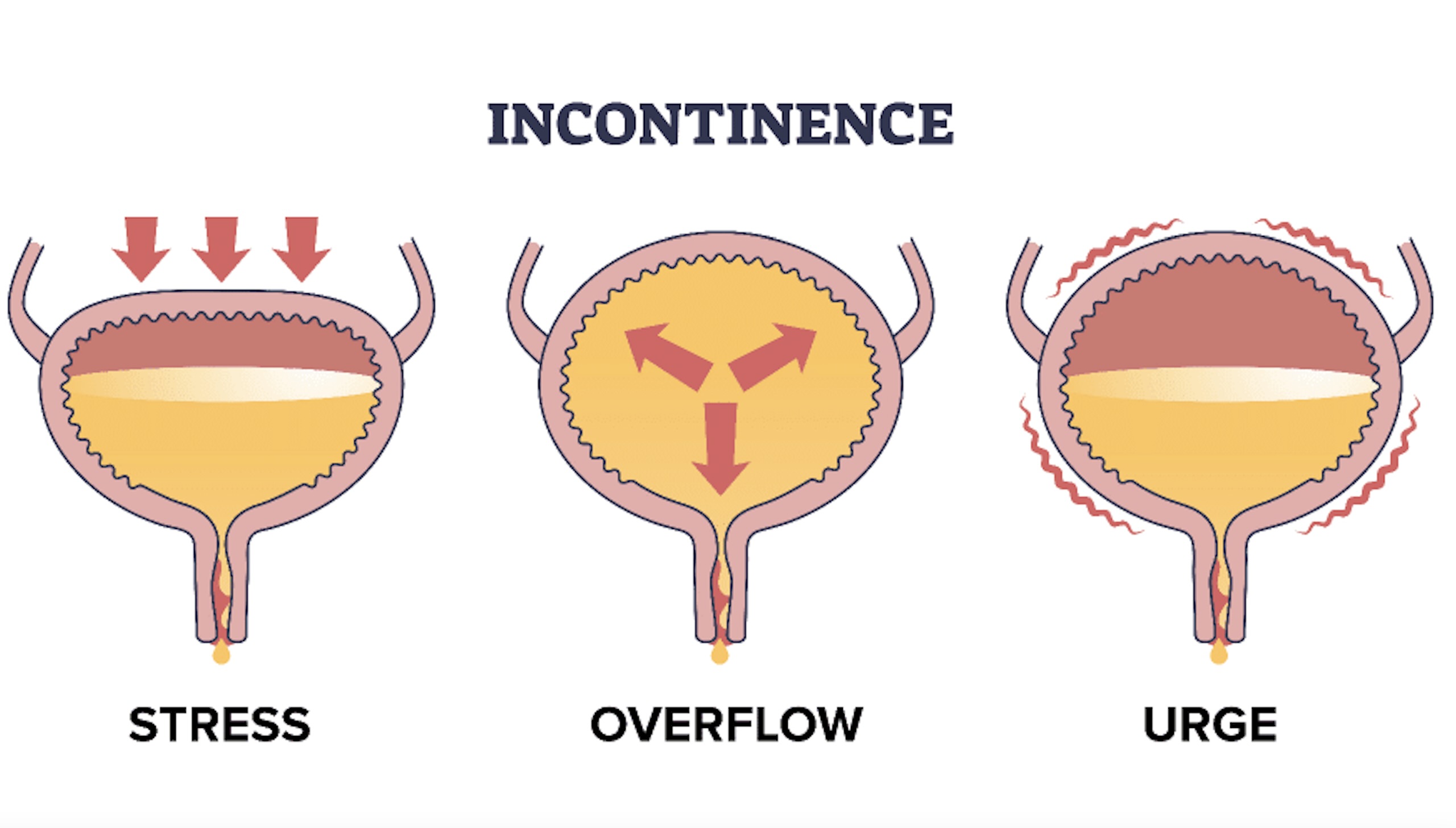 incontinence