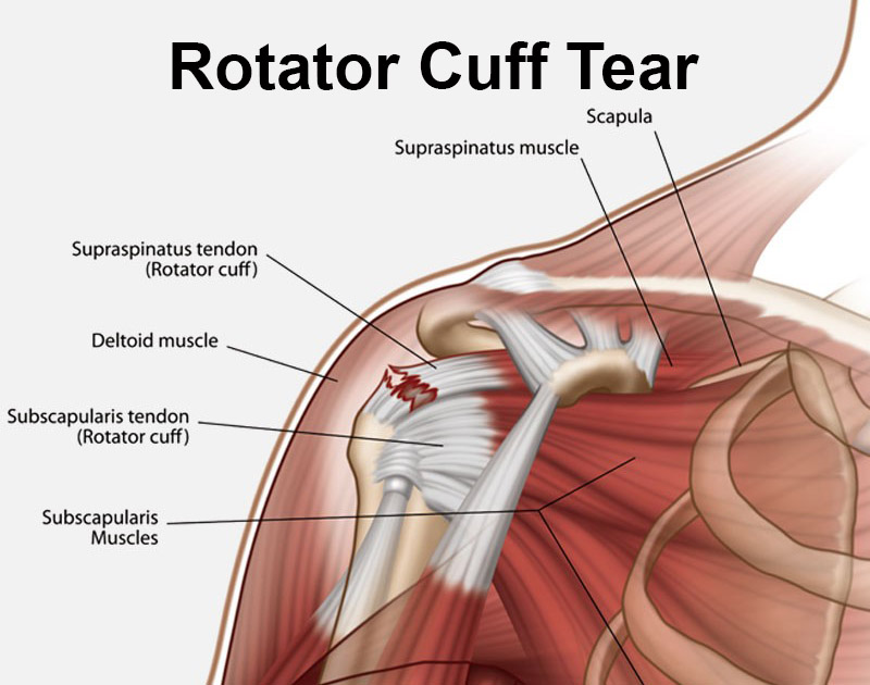 rotator cuff injury 