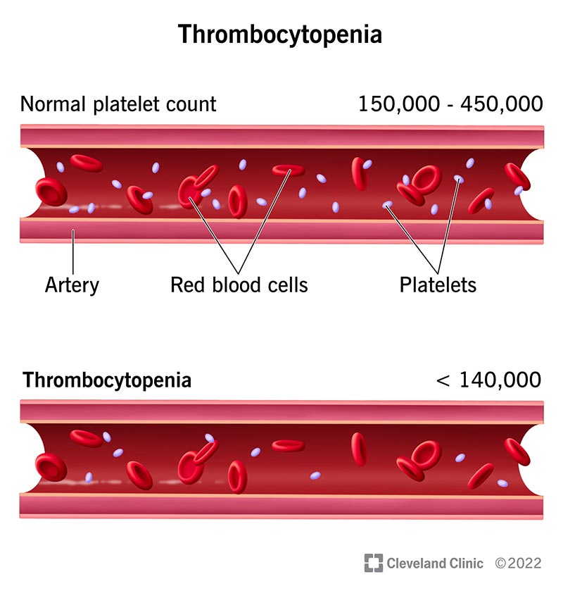 thrombocytopenia