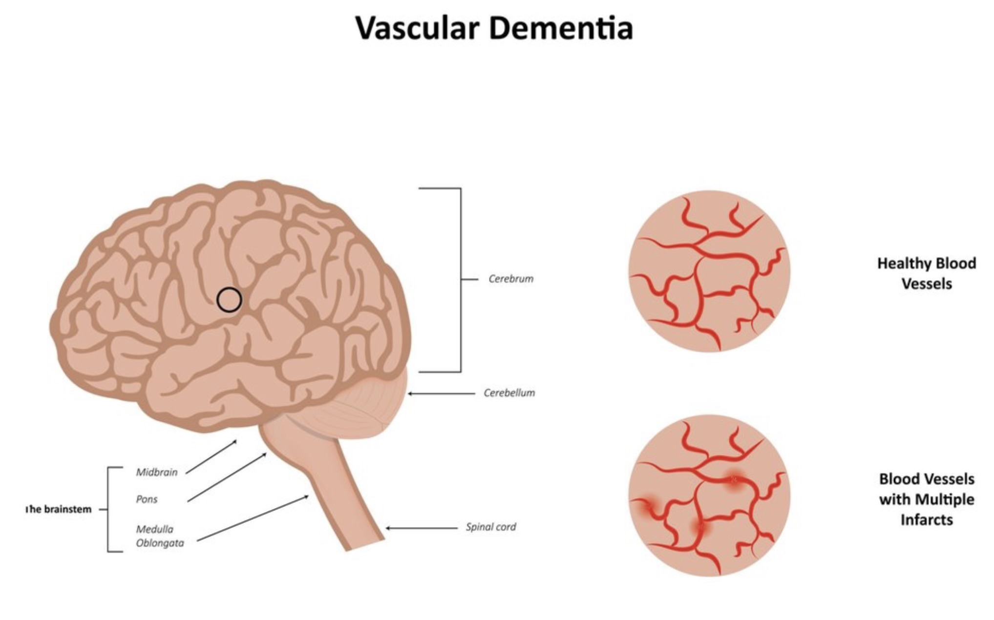 vascular dementia