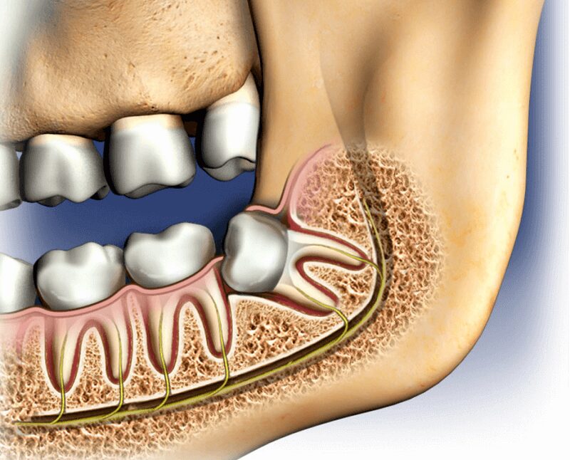 wisdom teeth